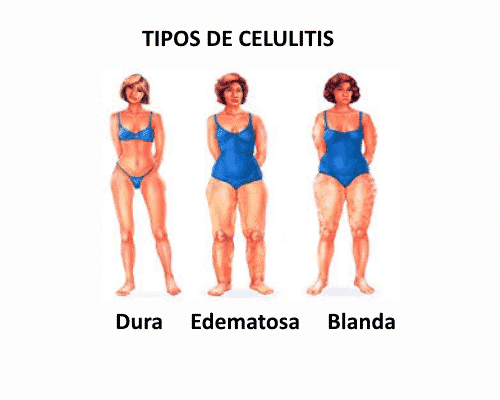 Celulitis Qué Es Tratamientos Y ¡más Todo Lo Que Necesitas Saber 