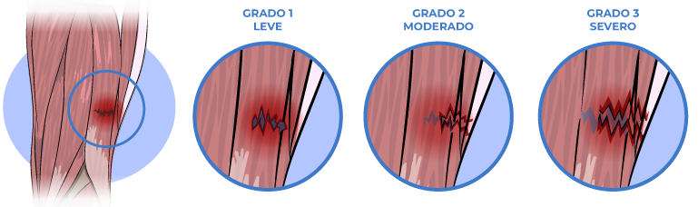 desgarro musculare